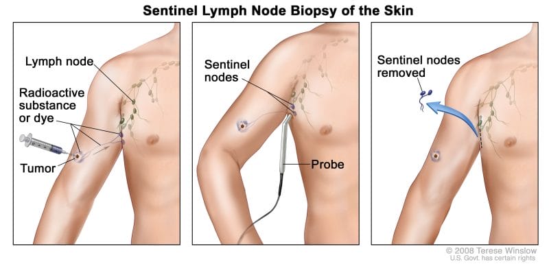 Sentinel Lymph Node Graphic
