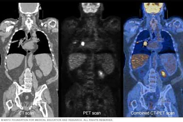 CT, PET, and CT-PET Scan Graphic